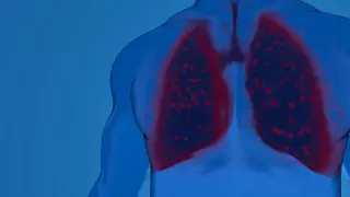 Что происходит с легкими спустя 3 года после COVID