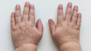 В ЗКО, предположительно от скарлатины, скончался ребенок