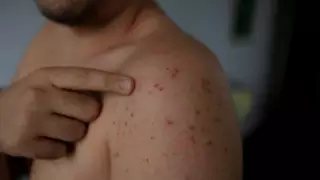 Почти три тысячи человек пролечились от кори в стационарах Астаны