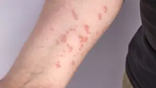 "Это не повод для самоуспокоения" - Бектенов о ситуации с оспой обезьян в Казахстане