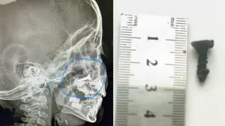 Ребенок полгода жил с шурупом в носу на юге Казахстана