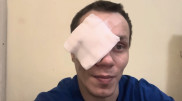Боец ММА лишился глаза после конфликта с девушкой