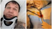 Легенда ММА Емельяненко показал кадры операции на позвоночнике