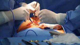 В Алматы врачи впервые в своей практике извлекли 5 499 камней из желчного пузыря пациента