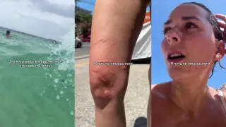 “Думала - водоросли“. Туристка едва не осталась без ноги во Вьетнаме