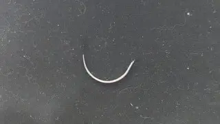 Повторная операция спасла жизнь казахстанцу: в его легком нашли иглу