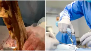 Органы разрушены, кишечник удален: 9 месяцев назад врачи забыли салфетку в животе алматинки