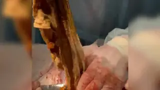 Алматинка 9 месяцев жила с салфеткой в животе: Минздрав отклонил жалобу