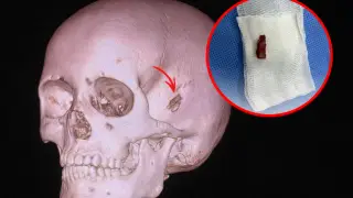 10-летний казахстанец 5 лет жил с куском ветки в голове