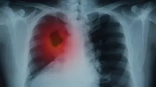 Врач назвал эффективный способ выявления рака легкого