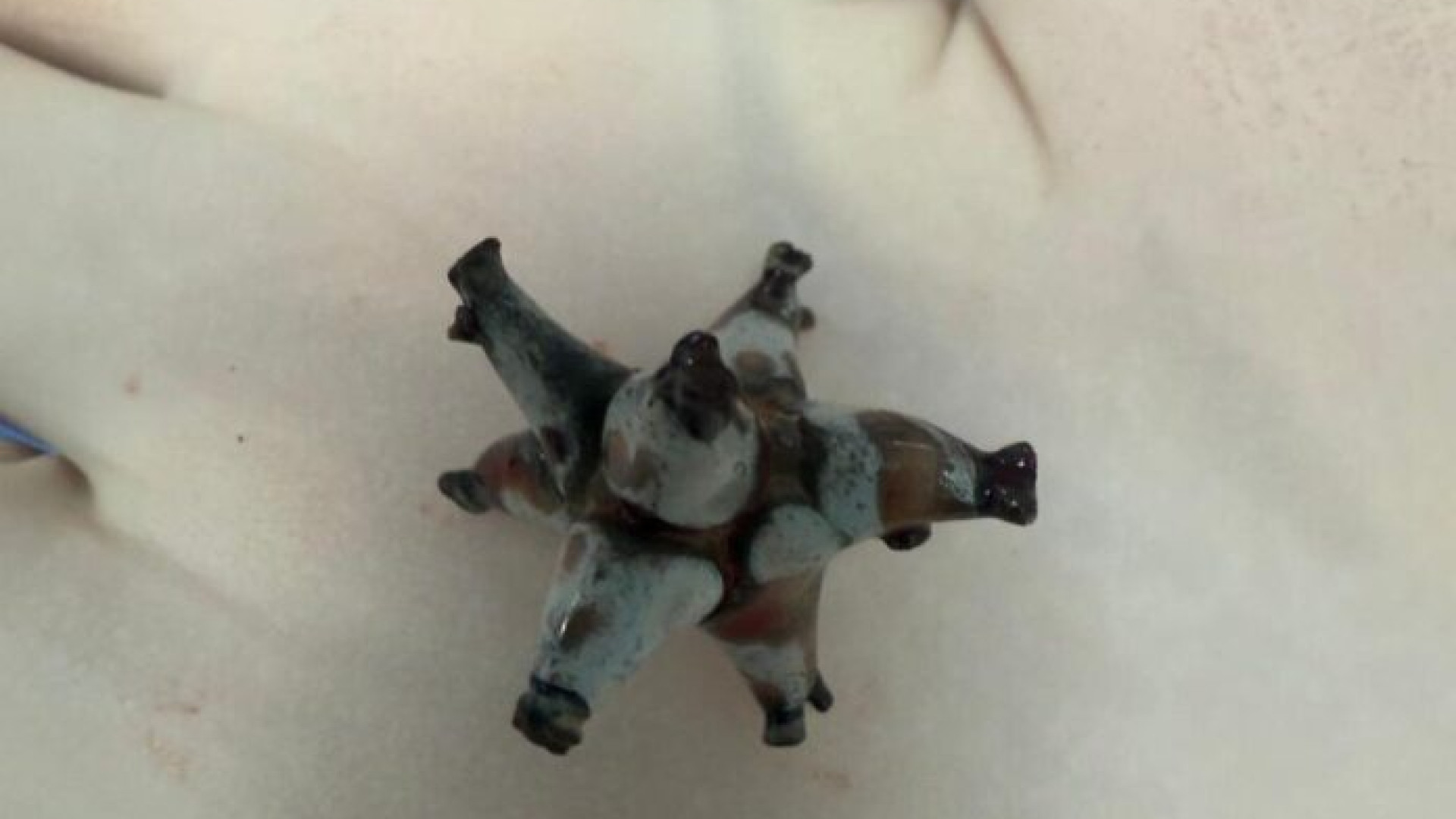 Шымкентские врачи удалили из почки пациента крупный камень необычной формы