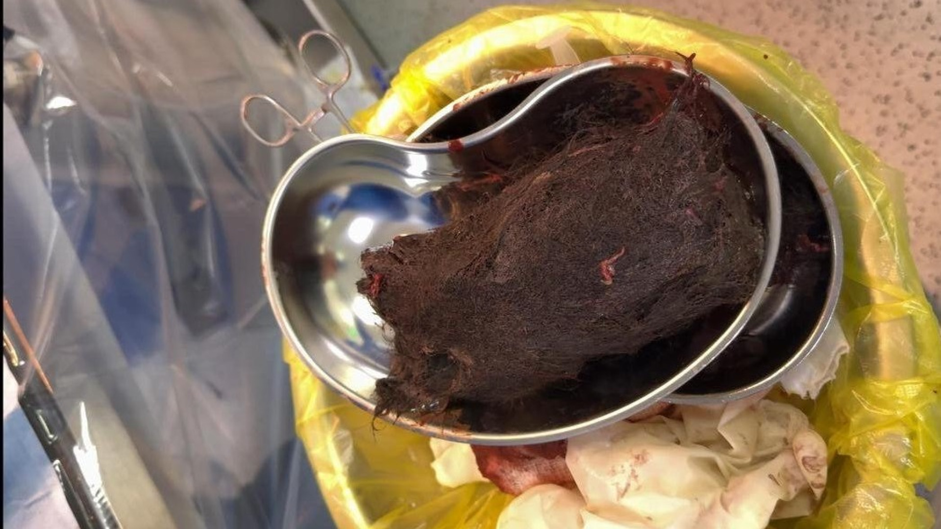 Почти килограмм волос нашли в желудке у девочки в Туркестанской области