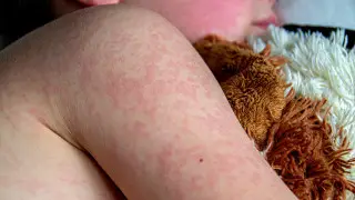 “Ситуация напряжённая“:  рост кори в Алматы и обращение главы Минздрава