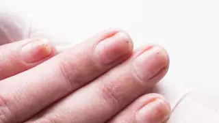 Врачи перечислили симптомы рака, которые видно сразу