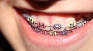Children of Kostanai oblast to have their teeth treated in a truck