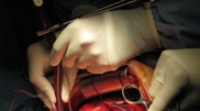 First Kazakhstan patient with artificial heart discharged