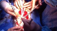 First partial heart implantation in CIS performed in Kazakhstan