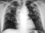 Silicosis suit could crush S.Africa's gold mining sector 