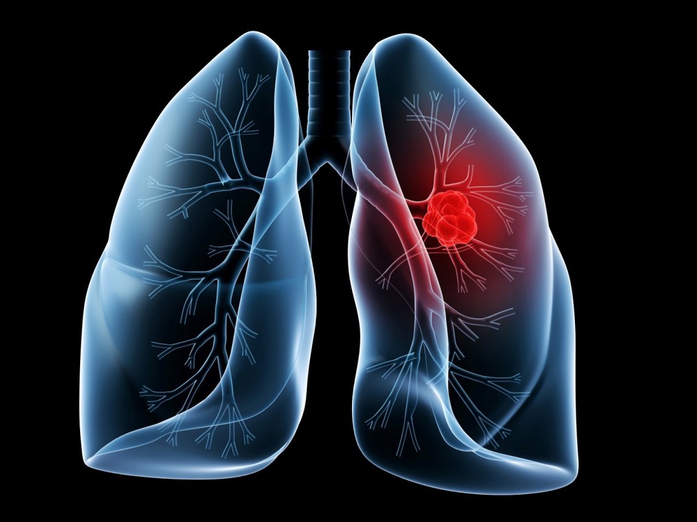 Antioxidants speed lung cancer growth in mice: study