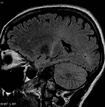 High-calorie diet may slow Lou Gehrig's disease