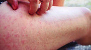 Maldives tourists bite by sand fleas leaving larvae under skin