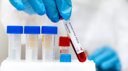 Kazakhstan's Ministry of Healthcare issues statement on monkeypox