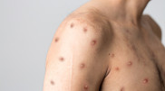 Kazakhstan conducts monkeypox response drills in airports