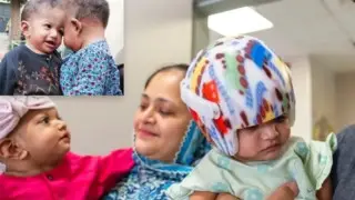 Conjoined twins fused at the head were successfully separated in Turkey