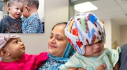 Conjoined twins fused at the head were successfully separated in Turkey