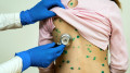 Chickenpox on the rise: number of sick children growing in Almaty