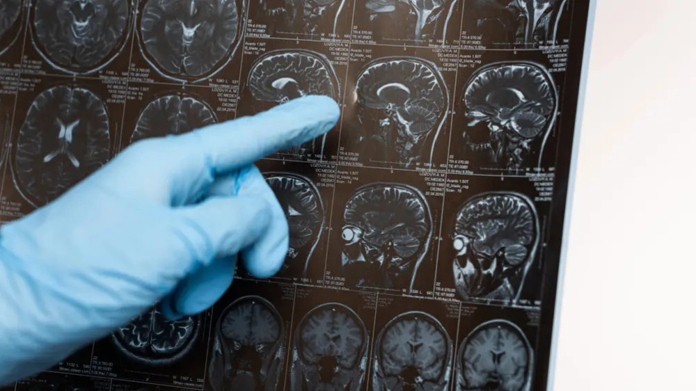 Unexpected factor affecting dementia development revealed