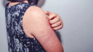 Another measles outbreak? Hundreds of children fall ill in Kazakhstan