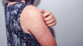 Another measles outbreak? Hundreds of children fall ill in Kazakhstan