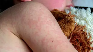 “The situation remains tense“: measles surge in Almaty and Health Minister’s appeal