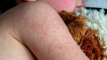 “The situation remains tense“: measles surge in Almaty and Health Minister’s appeal