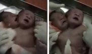 Бір денеде екі бас: Үндістанда сиам егіздері дүниеге келді