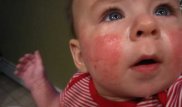 Балалар арасында аллергия өршіп тұр