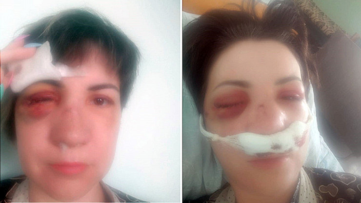 Лишил глаза: жителя Сарани осудили за жестокое избиение бывшей супруги