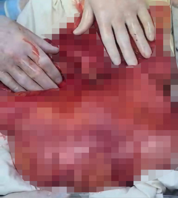 Кисту с червями весом 7,5 кг удалили у женщины в Алматы