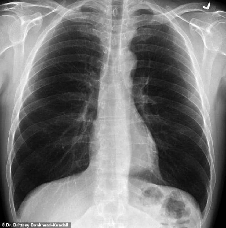Рентген здоровых легких фото с описанием